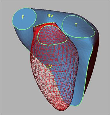 Right heart failure after left ventricular assist device: From mechanisms to treatments